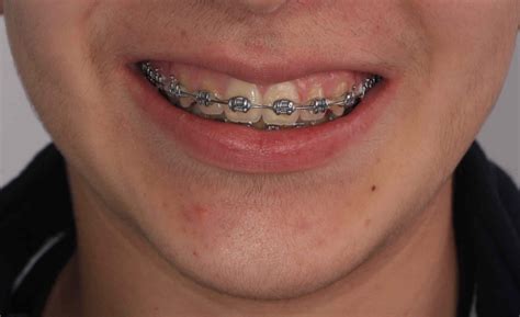 tipos de brackets metalicos y precios|cuanto cuesta un bracket.